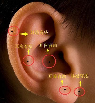 耳骨長痣|耳朵痣位置：影響健康？